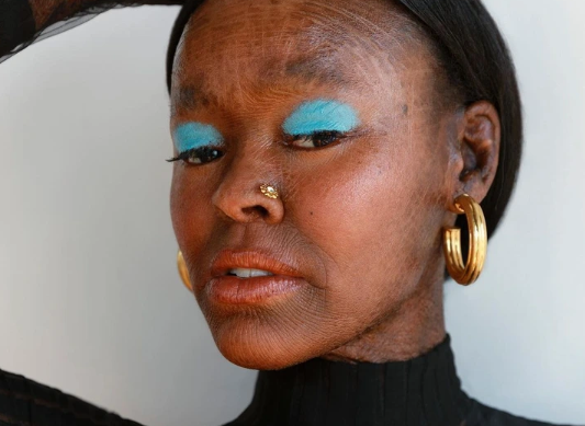 ” a Model With a Rare Skin Disorder Challenges the Beauty Industry ” a Model With a Rare Skin Disorder Challenges the Beauty Industry