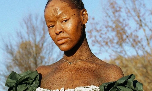” a Model With a Rare Skin Disorder Challenges the Beauty Industry ” a Model With a Rare Skin Disorder Challenges the Beauty Industry