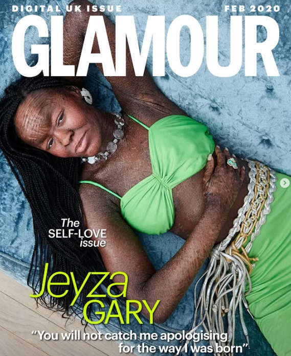 ” a Model With a Rare Skin Disorder Challenges the Beauty Industry ” a Model With a Rare Skin Disorder Challenges the Beauty Industry