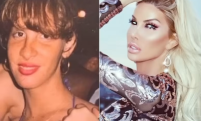 10 Most Extreme Celebrity Plastic Surgery Disasters: Facial Fusion