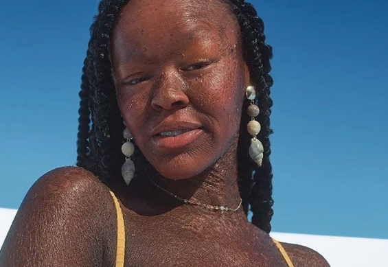 ” a Model With a Rare Skin Disorder Challenges the Beauty Industry ” a Model With a Rare Skin Disorder Challenges the Beauty Industry